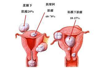 子宮腺肌癥最新治療進展與策略綜述