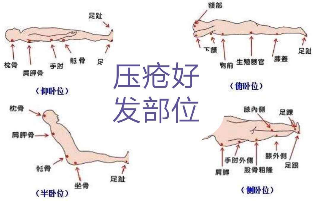 壓瘡分期與護理方法解析